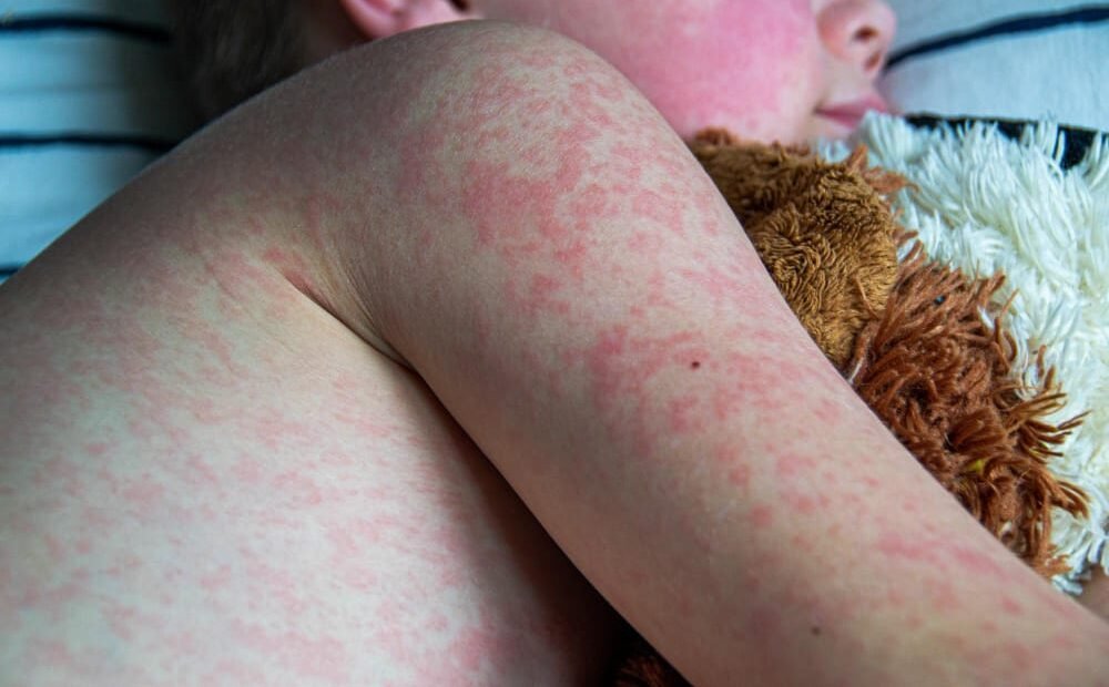 Kasus Campak Meningkat, Begini Cara Melindungi Diri di Ruang Publik