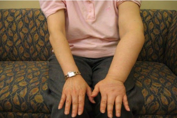 Ketika Pembengkakan Tak Kunjung Pergi, Mengenal Limfedema dan Sistem Getah Bening